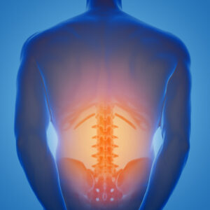 What Is Spinal Stenosis?